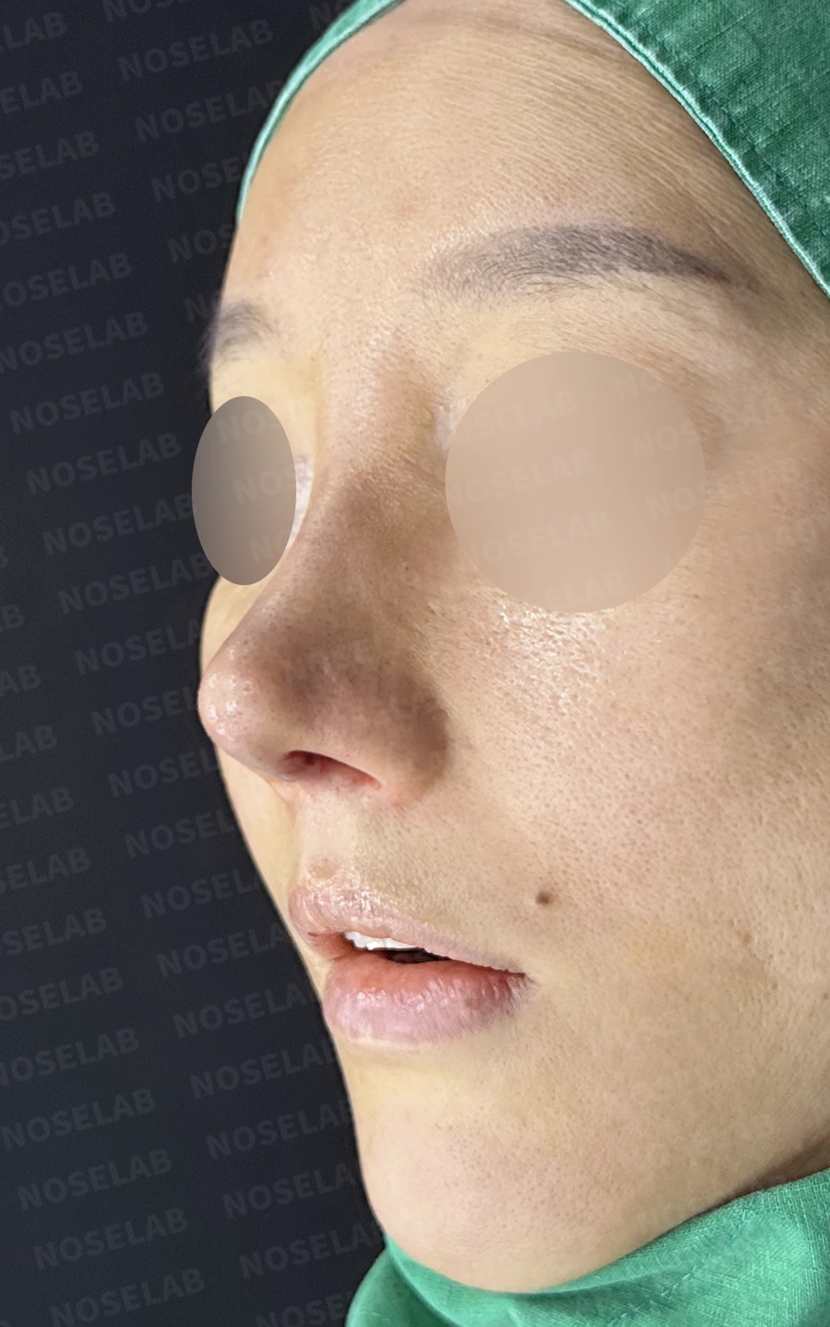 여러 번의 코재수술 뒤 비중격이 무너지는 이유, 자가늑연골 전면 재건은 어떻게 하나 — 수술 직후 0일 정면, 비스듬한 측면, 측면 사진입니다. 직후 사진은 부기가 있는 상태로 최종 결과와 다를 수 있습니다.