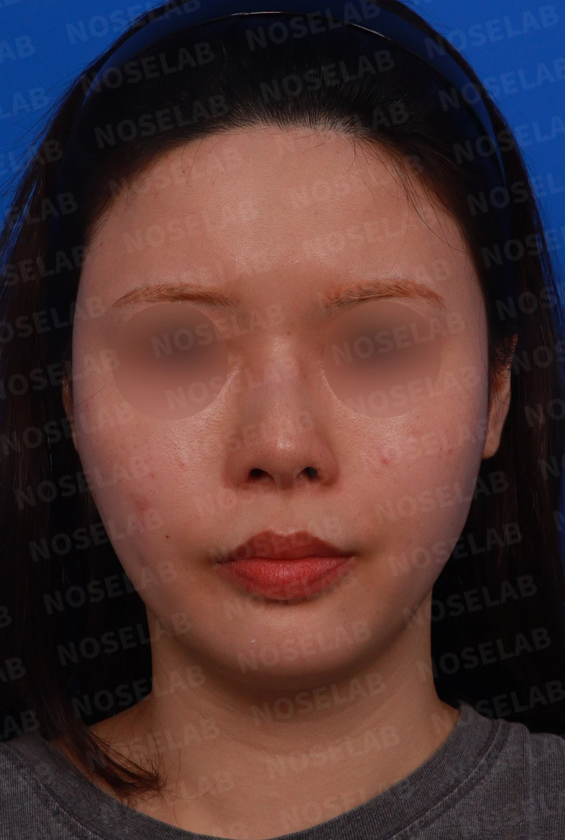 고개를 들면 콧구멍 모양이 다르고 코가 막히는 이유, 비중격 재건 방법 — 디자인 상담 정면 , 좌측 측면 , 비스듬한 측면 사진입니다.