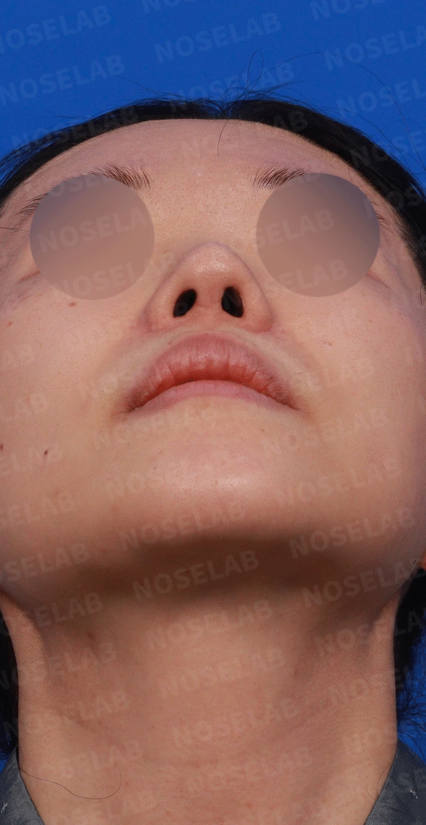 인공진피가 흡수되며 콧대가 낮아지고 퍼지는 이유 — 디자인 상담 우측 비스듬한 측면, 측면, 비공 사진입니다.