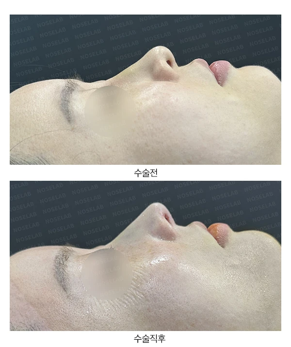 짧고 들린 코를 교정하는 재수술 방법 — 본문 사진 19