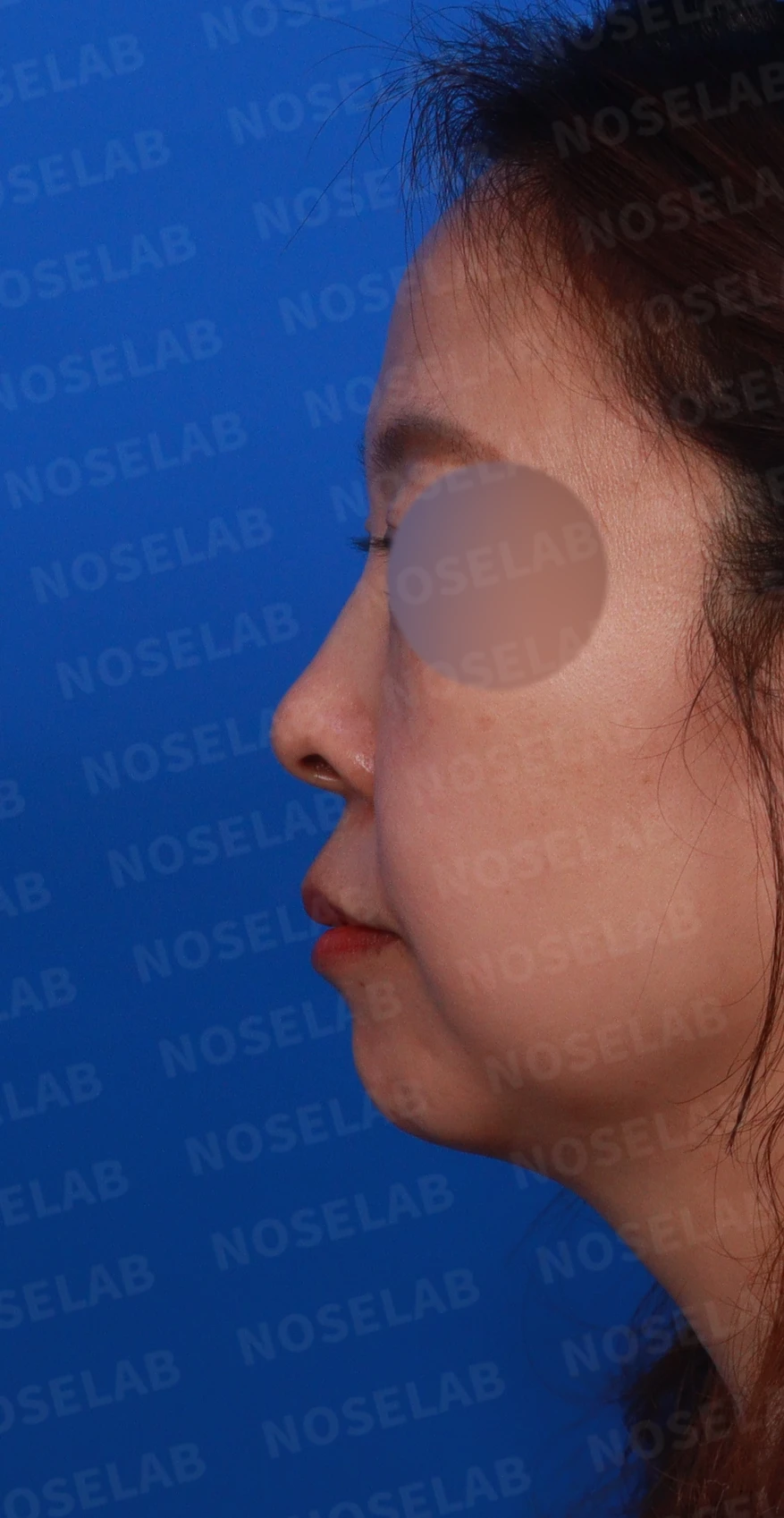 들창코에서 콧구멍이 많이 보이는 이유, 코끝 위치 교정은 어떻게 하나 — 디자인 상담 정면, 좌측 측면, 비스듬한 측면 사진