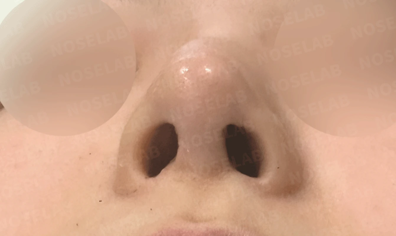 코끝 처짐과 코막힘을 함께 살펴보는 재수술 방법 — 본문 사진 16
