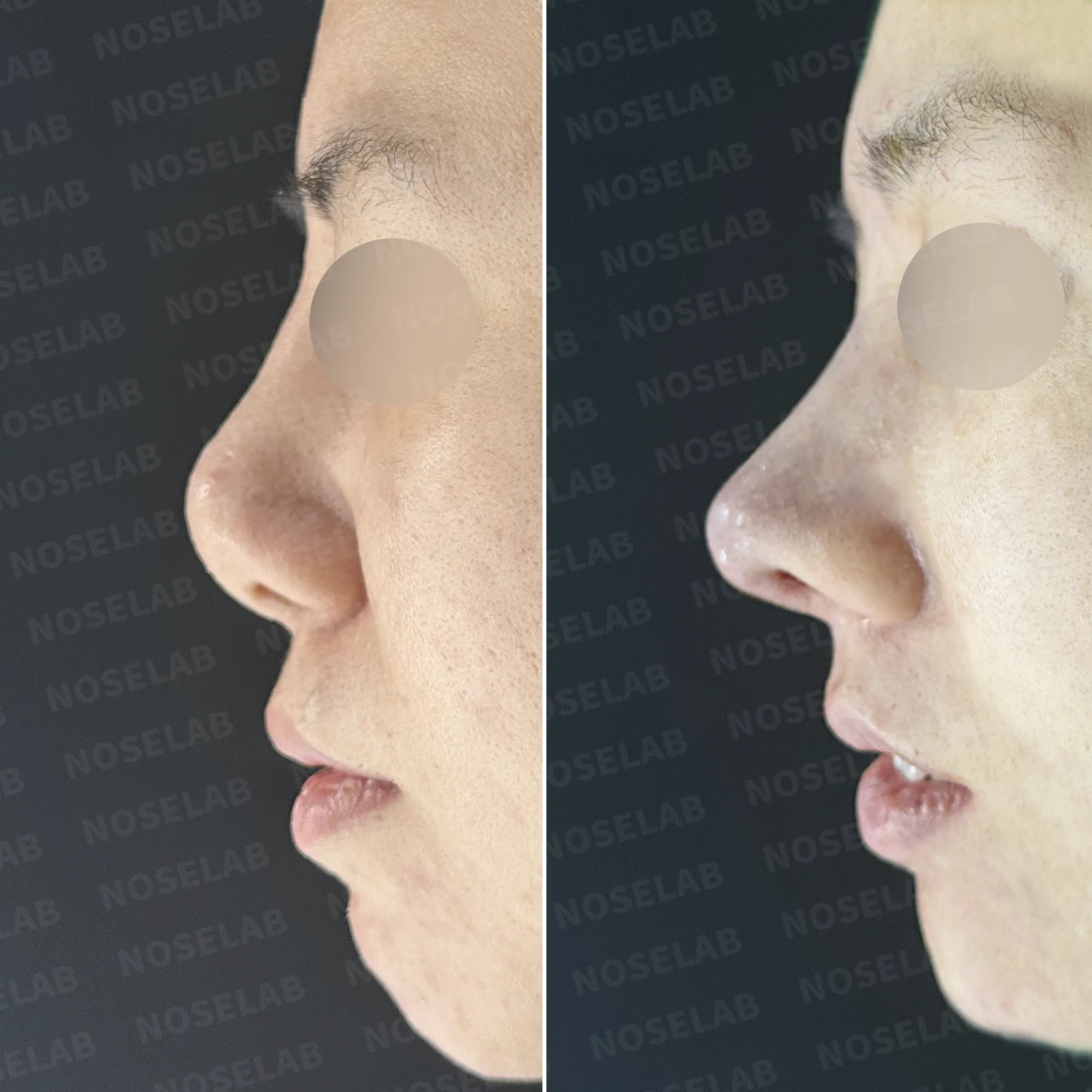 이전 수술 뒤 코가 딱딱해지고 짧아지는 구축, 왜 생기고 어떻게 재건하나 — 본문 사진 20