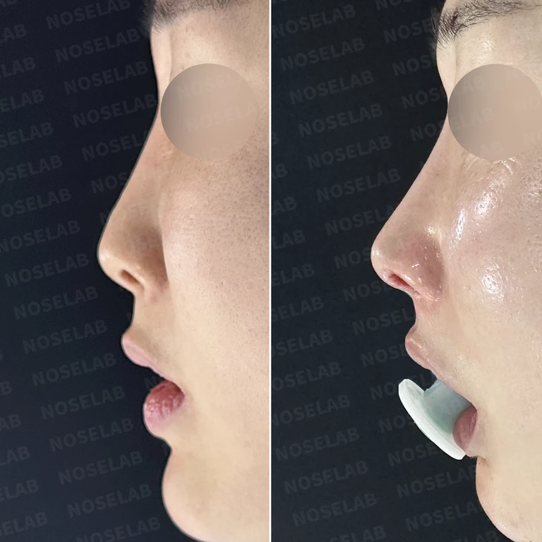 작은 코 고민, 자가늑연골과 맞춤형 보형물로 자연스러운 남자코성형 — 전후 비교