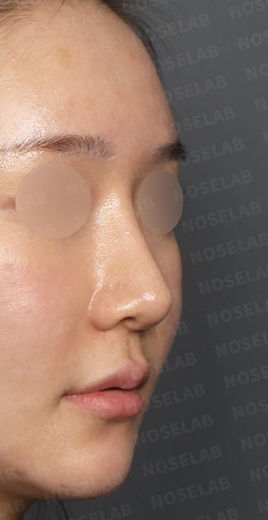 뭉툭하고 처진 긴코, 비개방 코재수술로 여성스러운 직반라인 완성 — 디자인 상담 우측 측면, 비스듬한 측면, 비공 사진입니다.