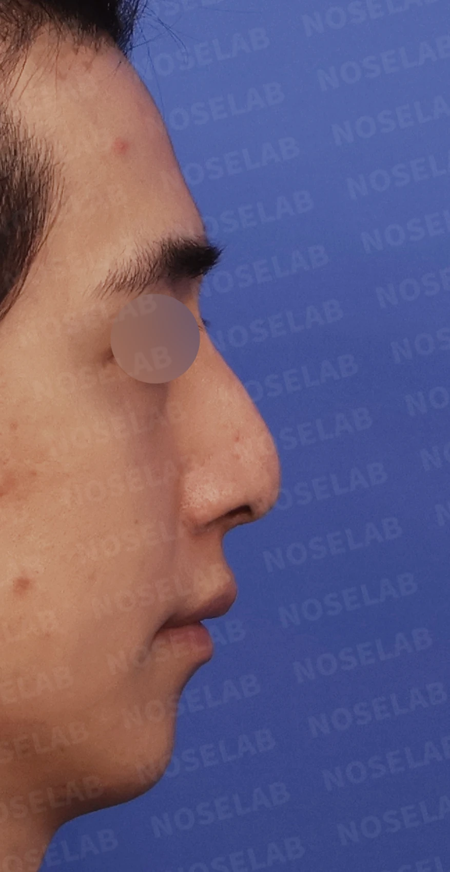 비중격이 한쪽으로 무너지면 왜 코막힘이 심해지는가 — 디자인 상담 우측 측면, 비스듬한 측면, 비공 사진입니다.