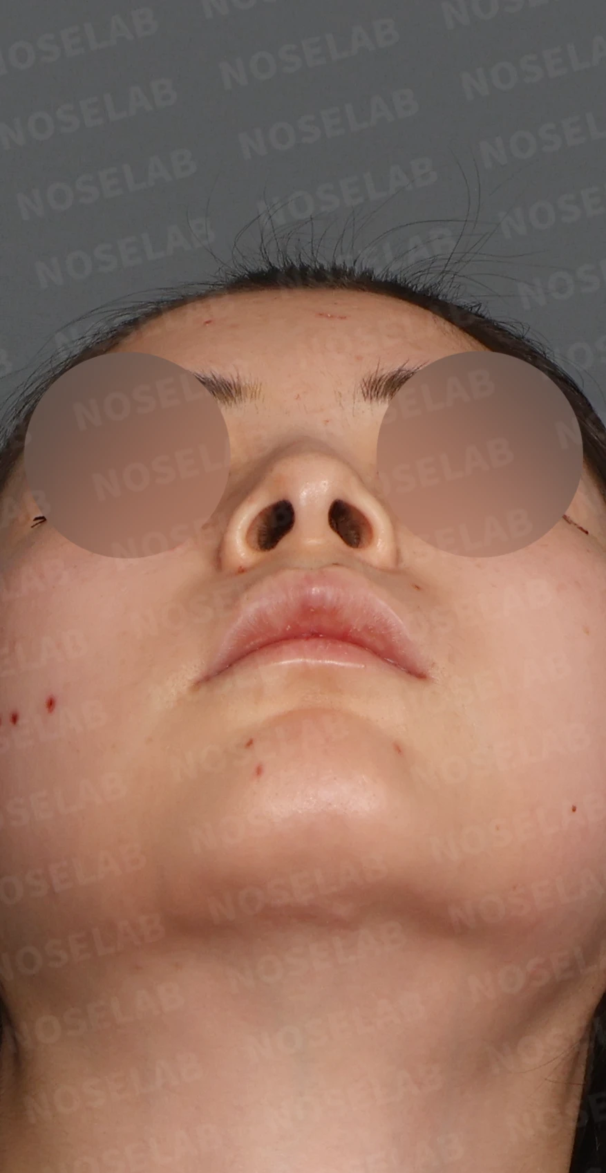 자가늑연골 코끝 성형과 매부리코·비순각 교정, 자연스럽고 화사한 코 라인 완성 — 디자인 상담 우측 측면 , 비스듬한 측면 , 비공 사진입니다.