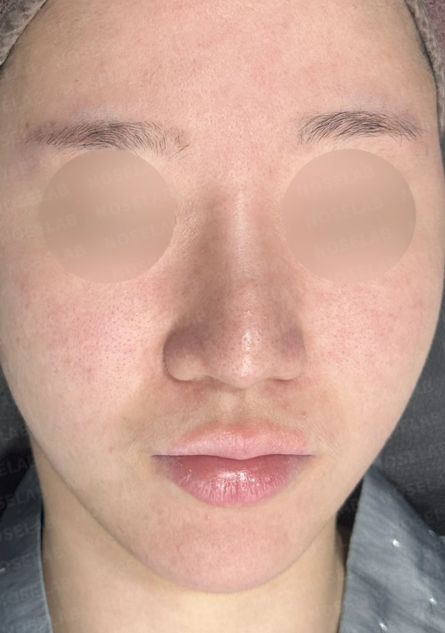 비중격 연골이 손상되면 코끝이 처지고 비주가 함몰되는 이유 — 본문 사진 7