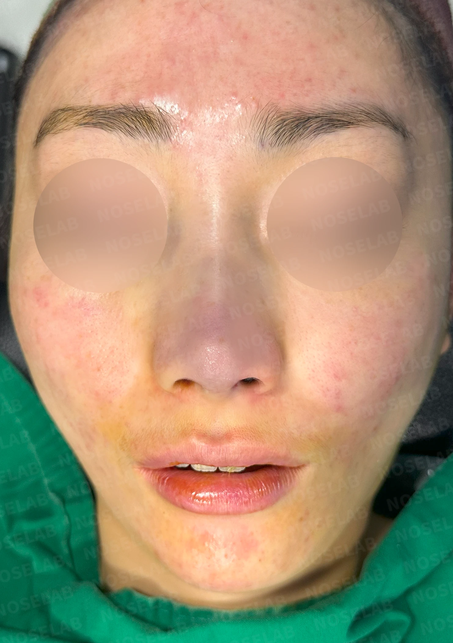 코끝이 뭉툭하게 퍼지고 코가 휘어 보이는 이유, 늑연골 재건은 어떻게 하나 — 수술 전 / 수술 직후 0일 직후 사진은 부기가 있는 상태로 최종 결과와 다를 수 있습니다.
