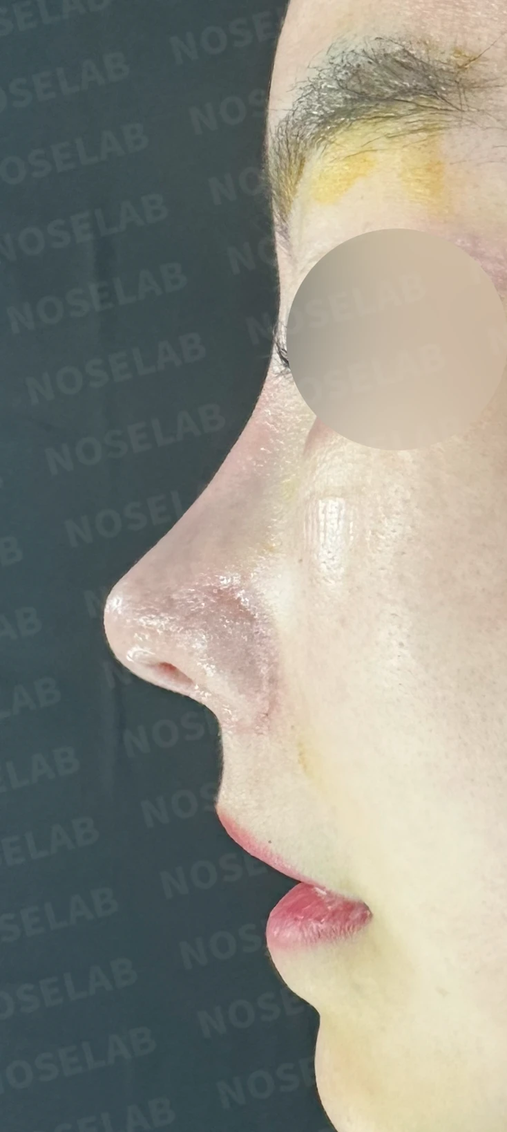 이식한 진피가 반복해서 흡수되는 이유, 재건은 어떻게 하나 — 수술 전 / 수술 직후 0일 직후 사진은 부기가 있는 상태로 최종 결과와 다를 수 있습니다.