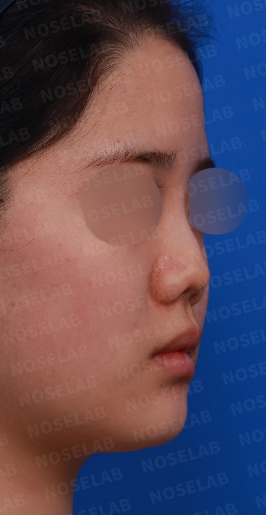 이전 수술 뒤 콧구멍이 좁아지는 비공협착, 원인과 재건 방법 — 디자인 상담 우측 측면, 비스듬한 측면, 비공 사진입니다.