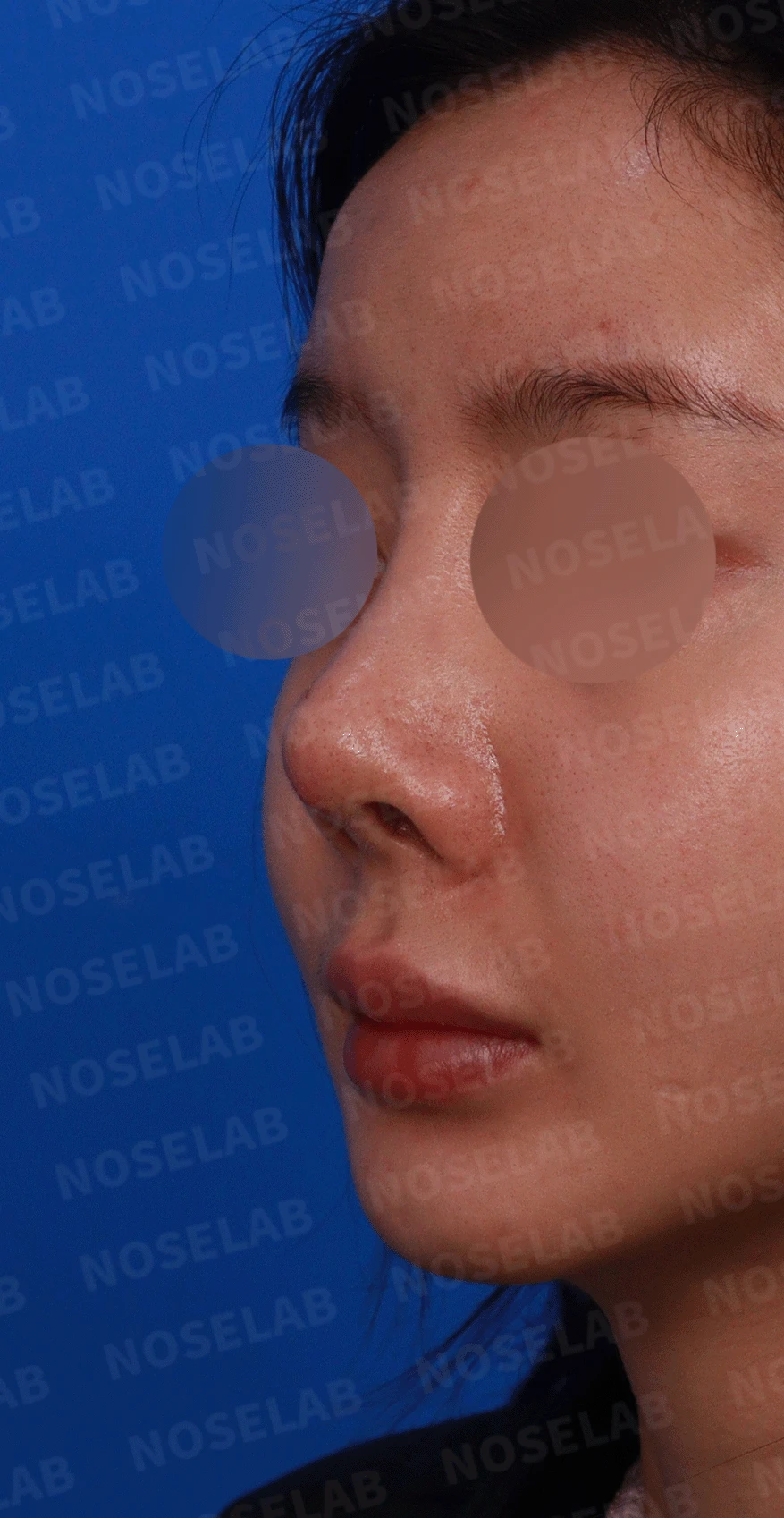 실리콘 보형물이 코끝 피부를 뚫고 나오려 할 때, 왜 생기고 어떻게 재건하나 — 디자인 상담 정면, 좌측 측면, 비스듬한 측면 사진