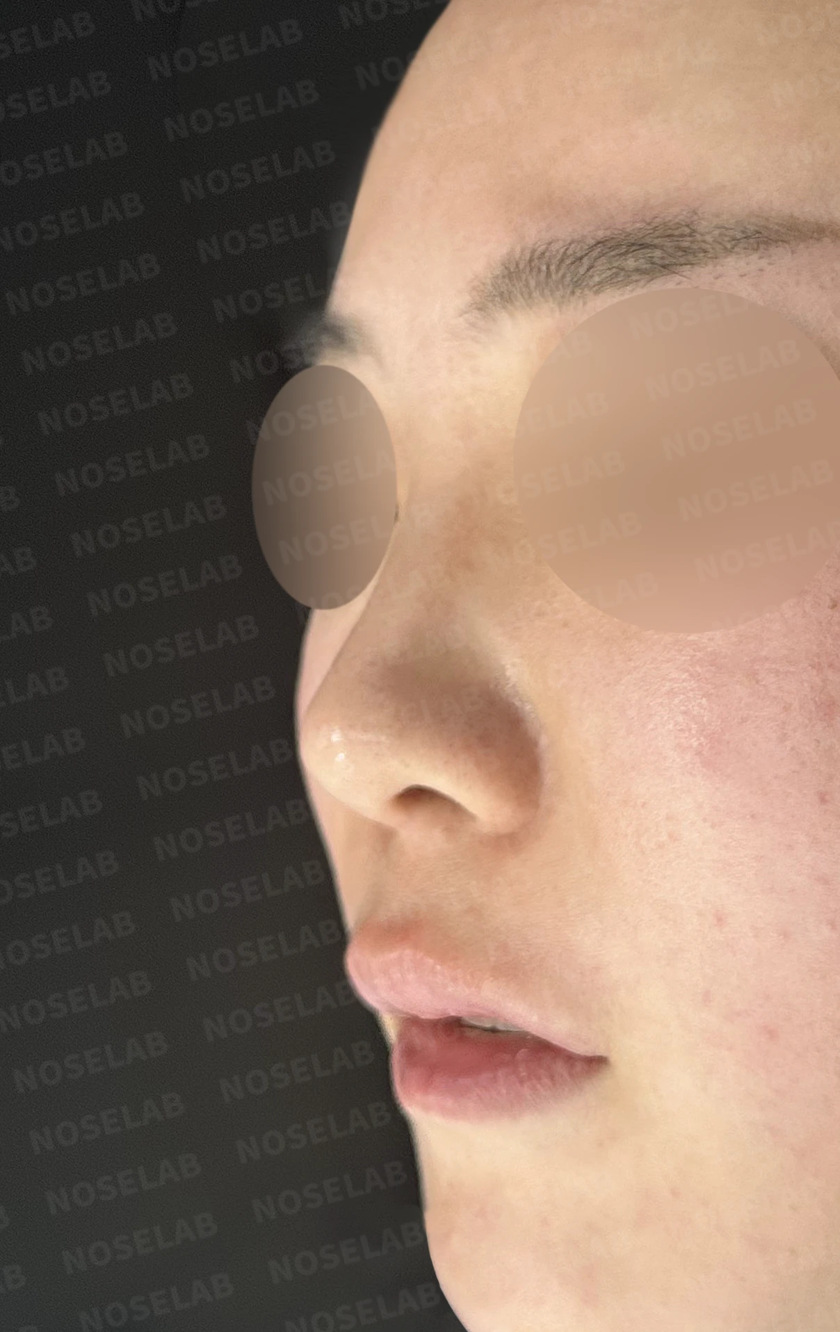 들린코 교정과 코막힘 개선, 자가늑연골로 코재수술 후기 — 전(좌) 직후(후)