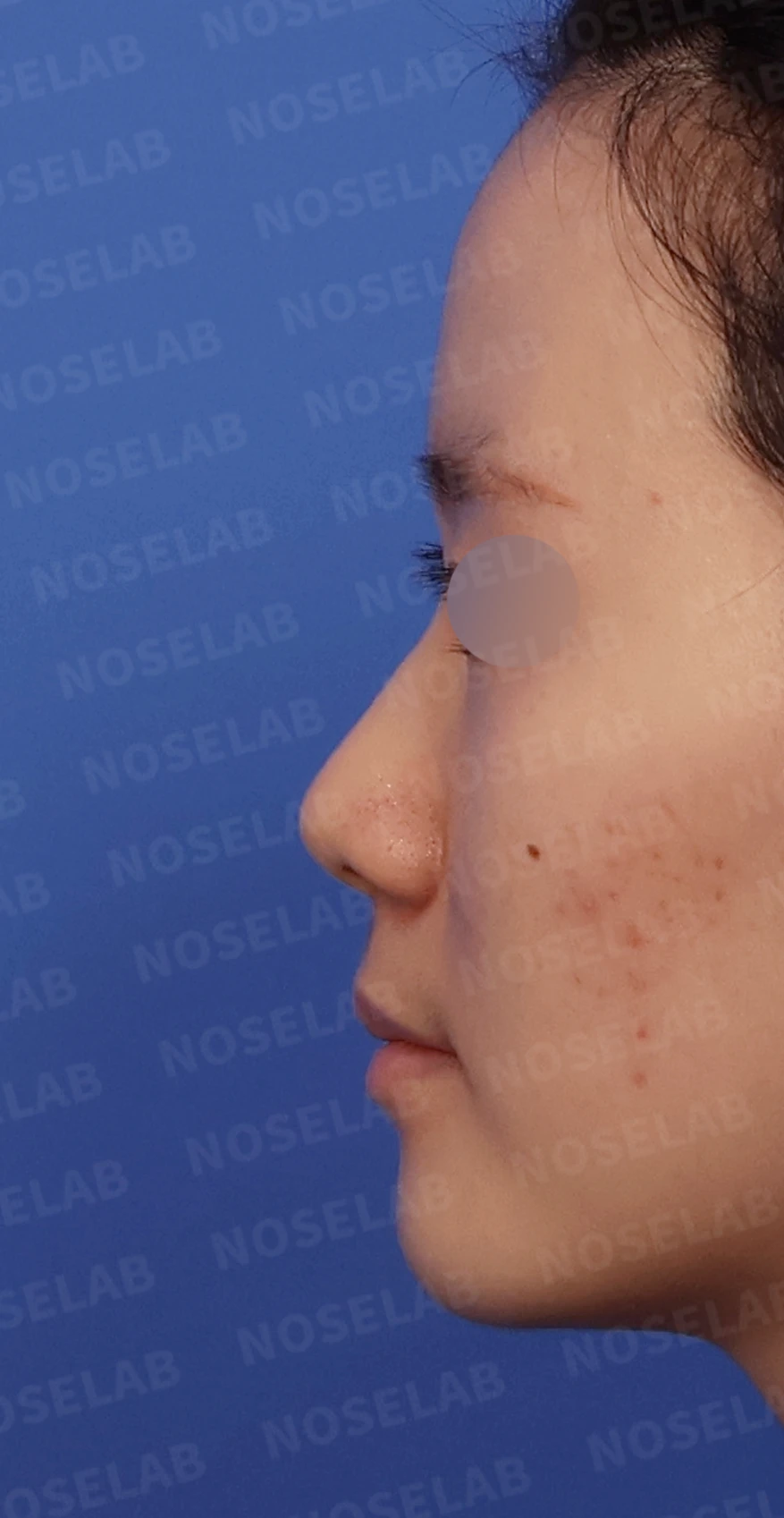 콧대가 퍼져 보이고 코끝이 뭉툭한 이유, 절골술과 자가 늑연골 교정은 어떻게 하나 — 디자인 상담 정면, 좌측 측면, 비스듬한 측면 사진입니다.