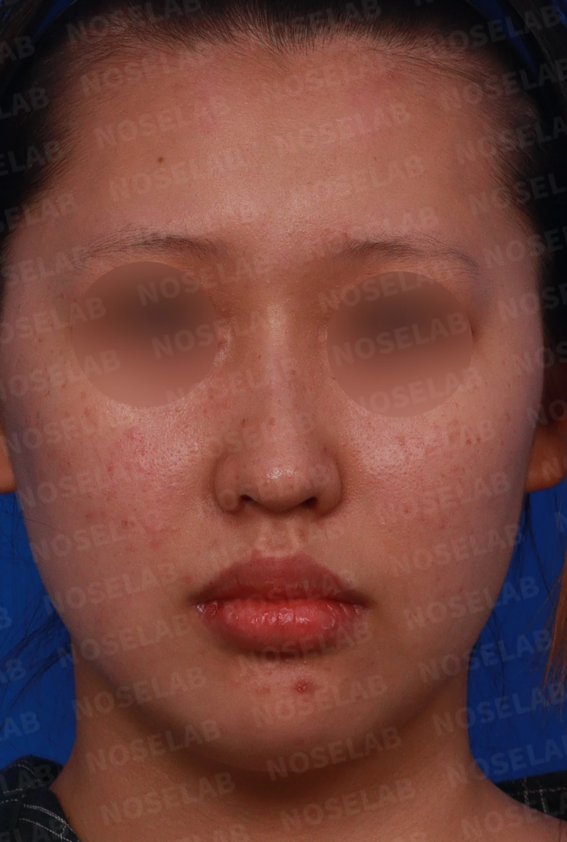 매부리코와 처진 코끝이 함께 있을 때, 콧대와 코끝의 균형 잡는 법 — 디자인 상담 정면 , 좌측 비스듬한 측면 , 측면 사진입니다.