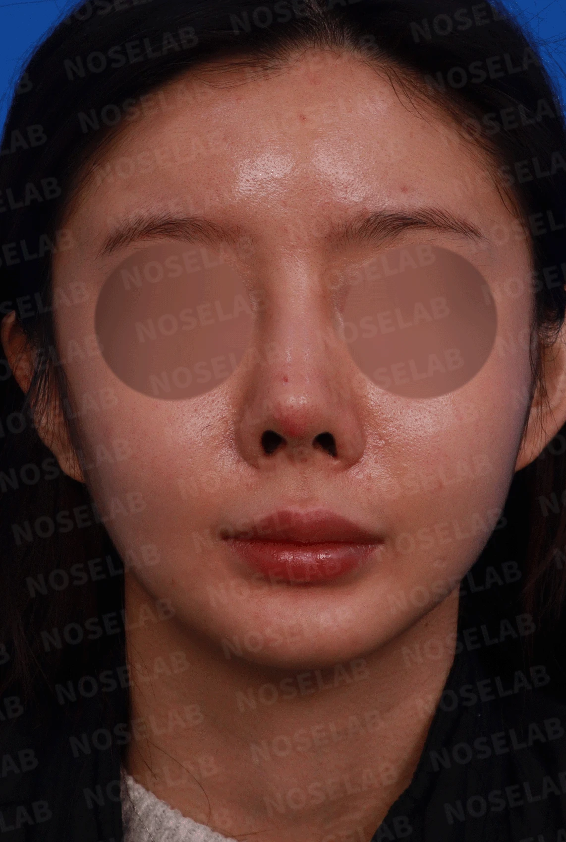 실리콘 보형물이 코끝 피부를 뚫고 나오려 할 때, 왜 생기고 어떻게 재건하나 — 디자인 상담 정면, 좌측 측면, 비스듬한 측면 사진