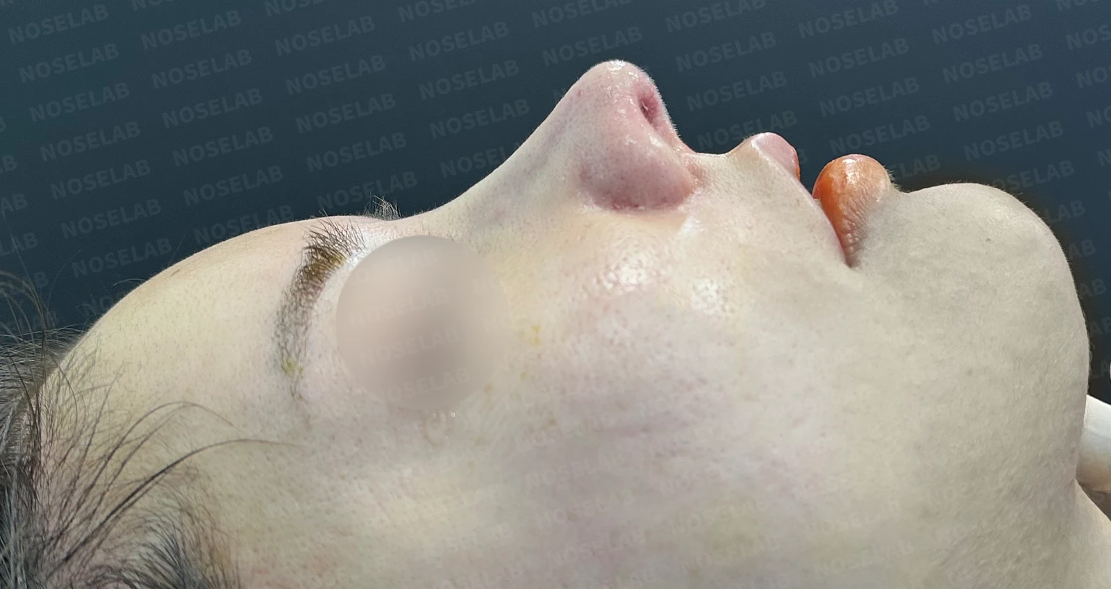 복코 교정과 비주 내리기 방법 — 수술 전 / 수술 직후 0일 직후 사진은 부기가 있는 상태로 최종 결과와 다를 수 있습니다.