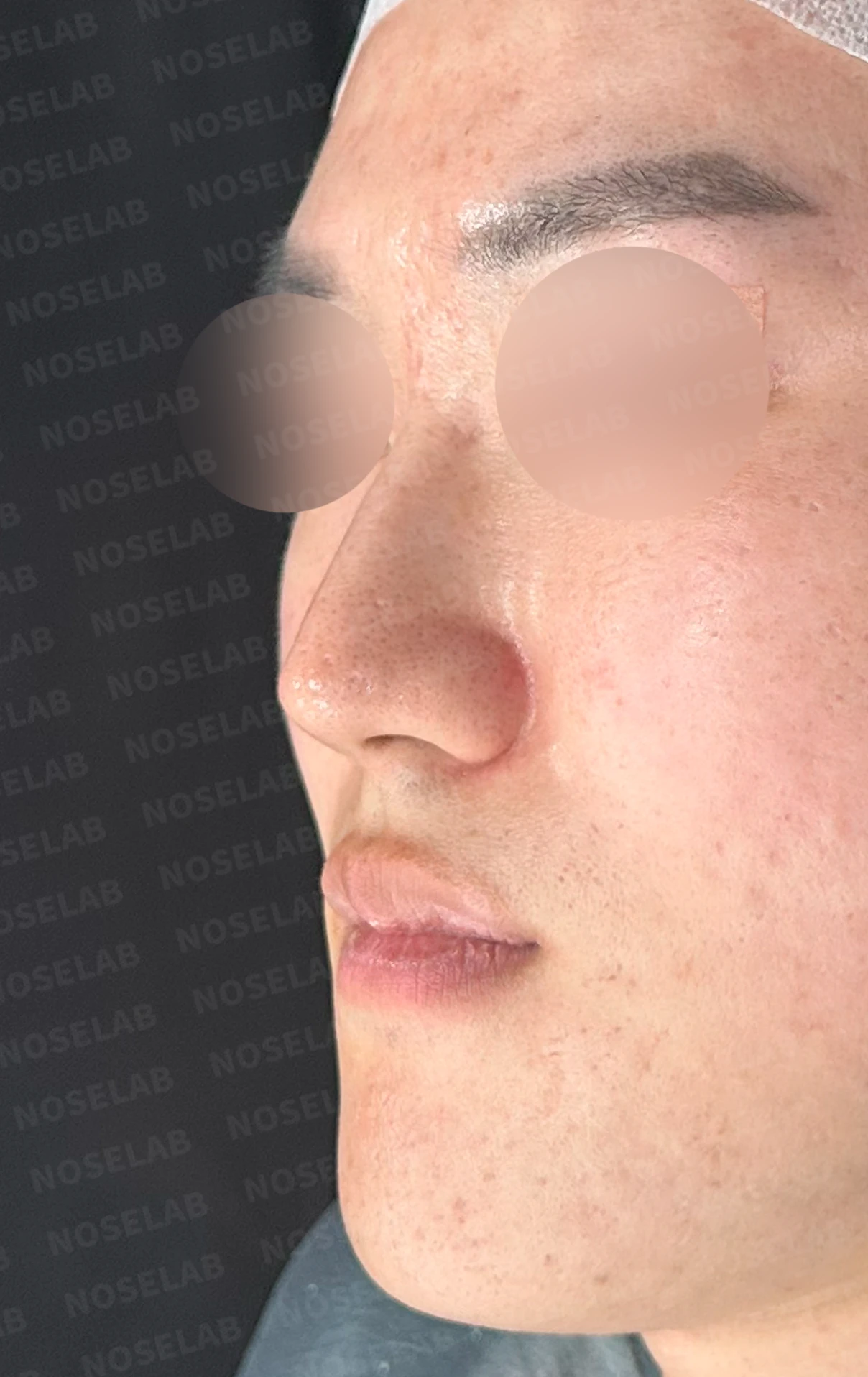 보형물 없이 코끝과 경계 부분만 교정하는 방법 — 본문 사진 11