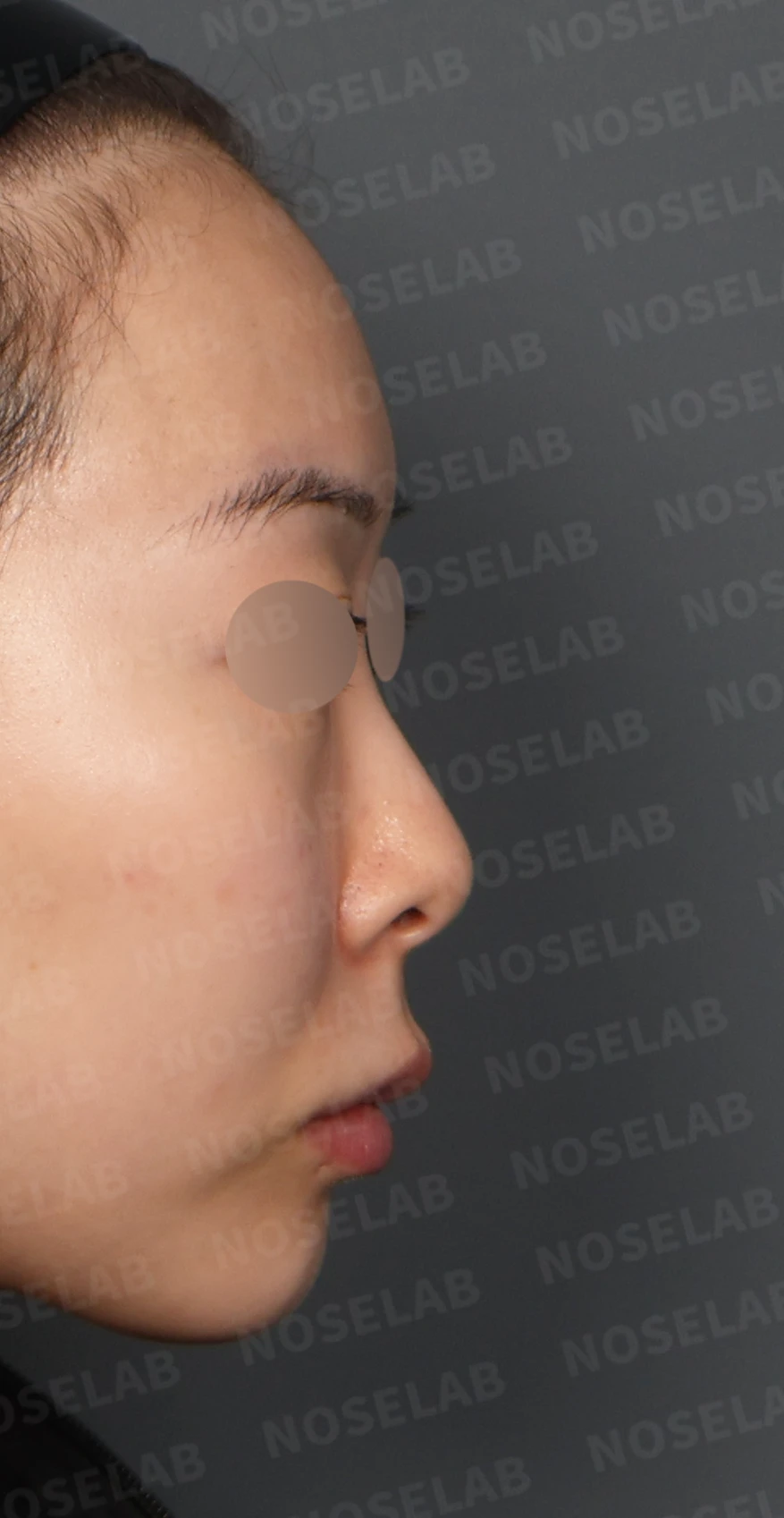 작고 낮은 코, 자가늑연골로 비순각 교정까지 한 번에 완성한 비개방 코성형 — 디자인 상담 우측 측면, 비스듬한 측면, 비공 사진입니다.