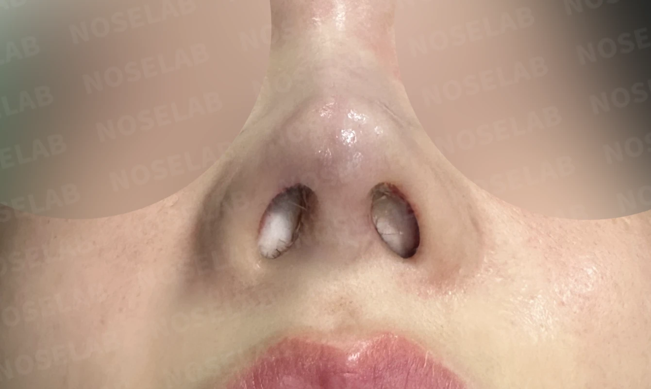 여러 차례 코수술 후 자가늑연골과 자가진피로 코 전체를 자연스럽게 높인 재수술 — 수술직후 비공 사진입니다.