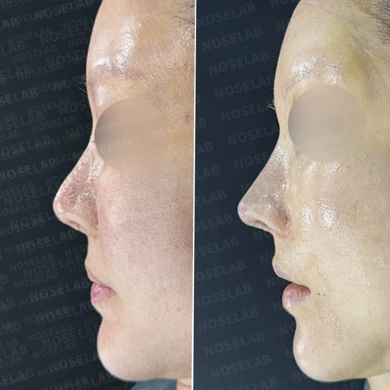 6번의 재수술 끝에 찾은 자연스러운 코, 자가늑연골 재건 이야기 — 전후 비교