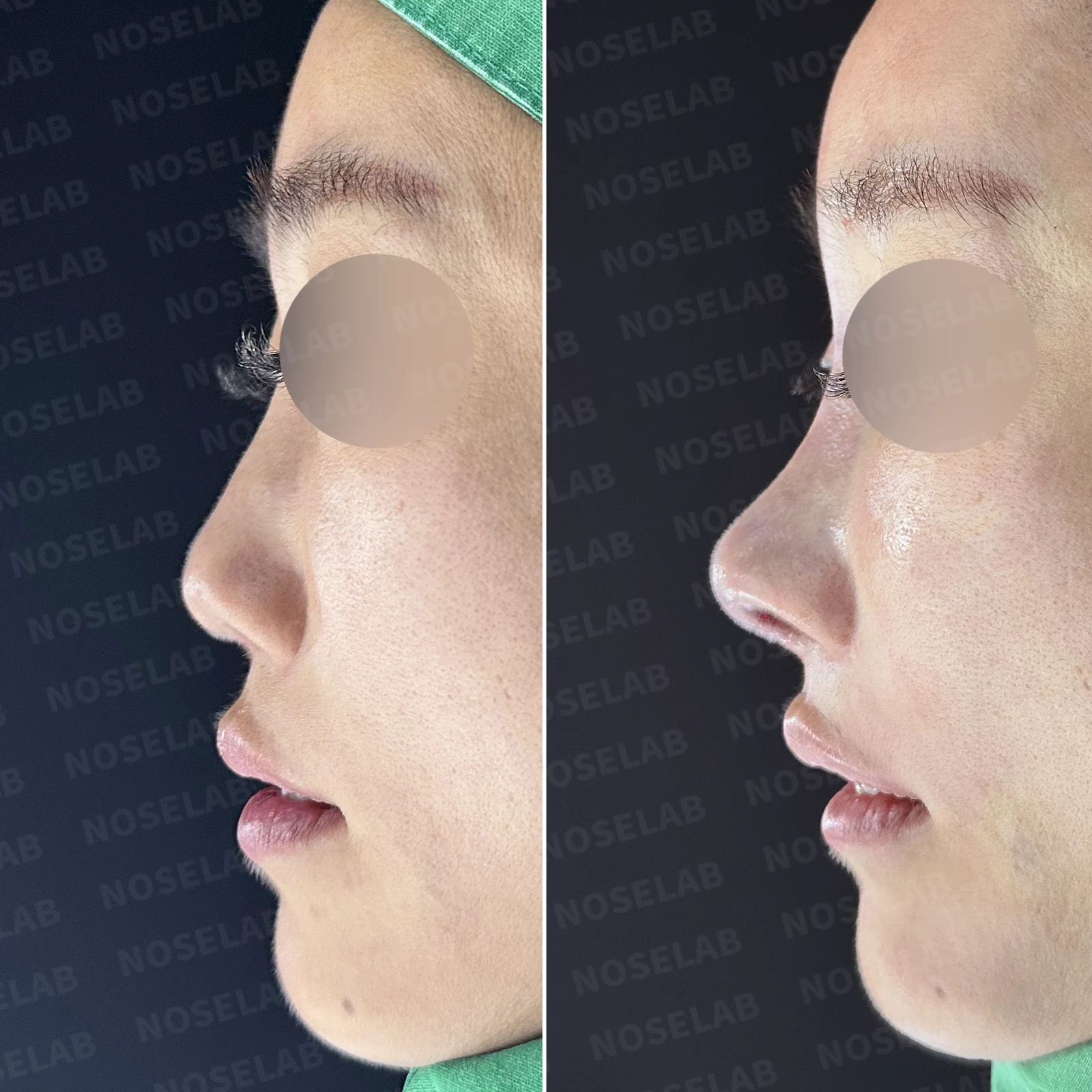 콧대에 주입한 불법 시술 이물질, 제거와 비중격 전체 재건은 어떻게 하나 — 본문 사진 20
