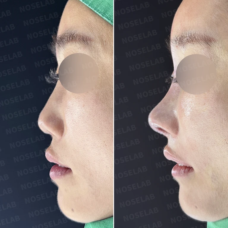 야매주사 이물질 제거와 비중격 전체 재건 — 전후 비교