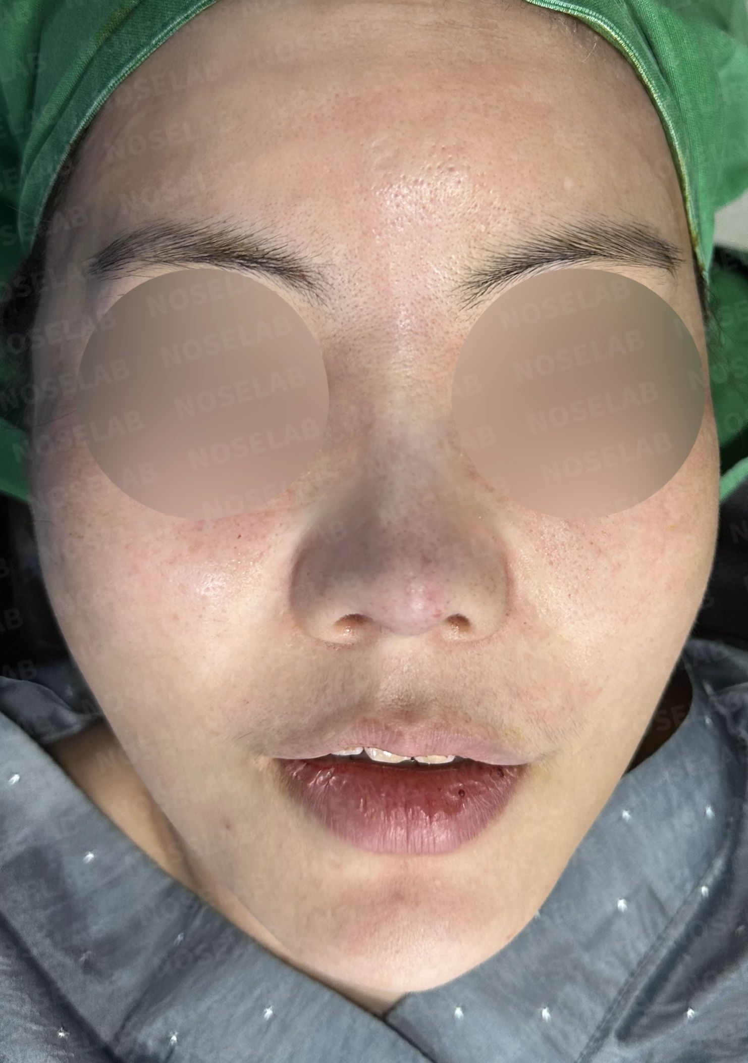 L자 실리콘 보형물이 비주 점막을 뚫기 직전까지 가는 이유, 제거와 자가늑연골 재건 방법 — 수술 직후 0일 정면, 비스듬한 측면, 측면 사진 직후 사진은 부기가 있는 상태로 최종 결과와 다를 수 있습니다.