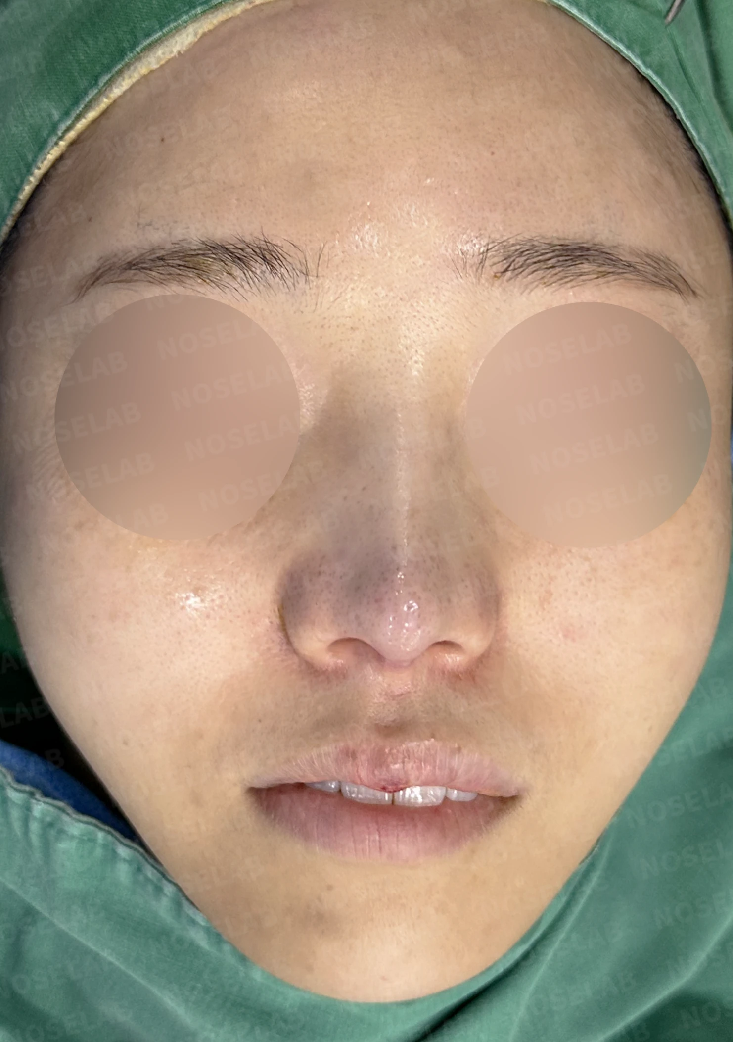 코끝 피부가 얇아져 연골이 비치는 이유, 피부 보강은 어떻게 하나 — 수술 전 / 수술 직후 0일 직후 사진은 부기가 있는 상태로 최종 결과와 다를 수 있습니다.