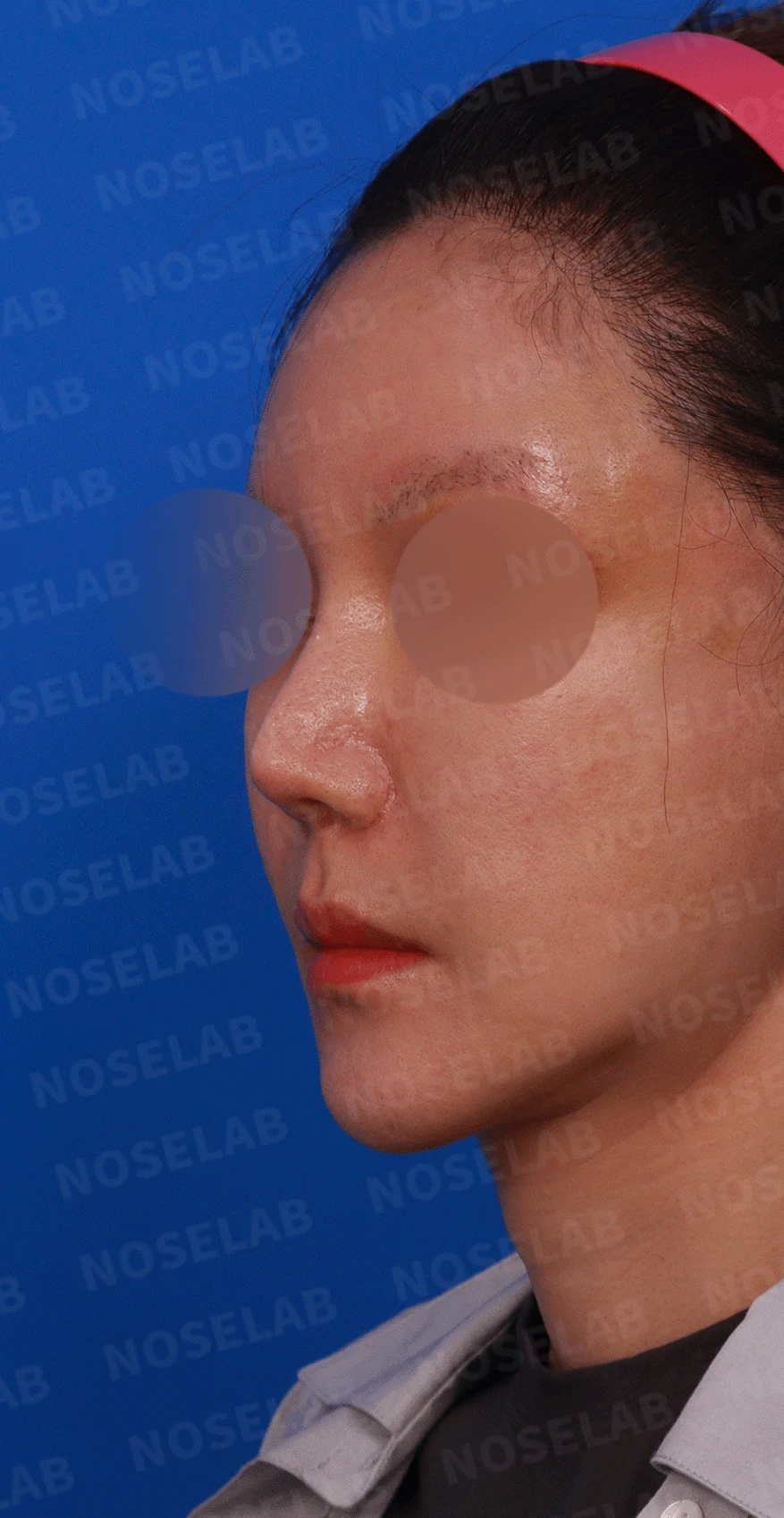 여러 차례 재수술로 코에 쓸 연골이 남지 않았을 때, 재건은 어떻게 하나 — 디자인 상담 정면 , 좌측 비스듬한 측면 , 측면 사진 입니다.