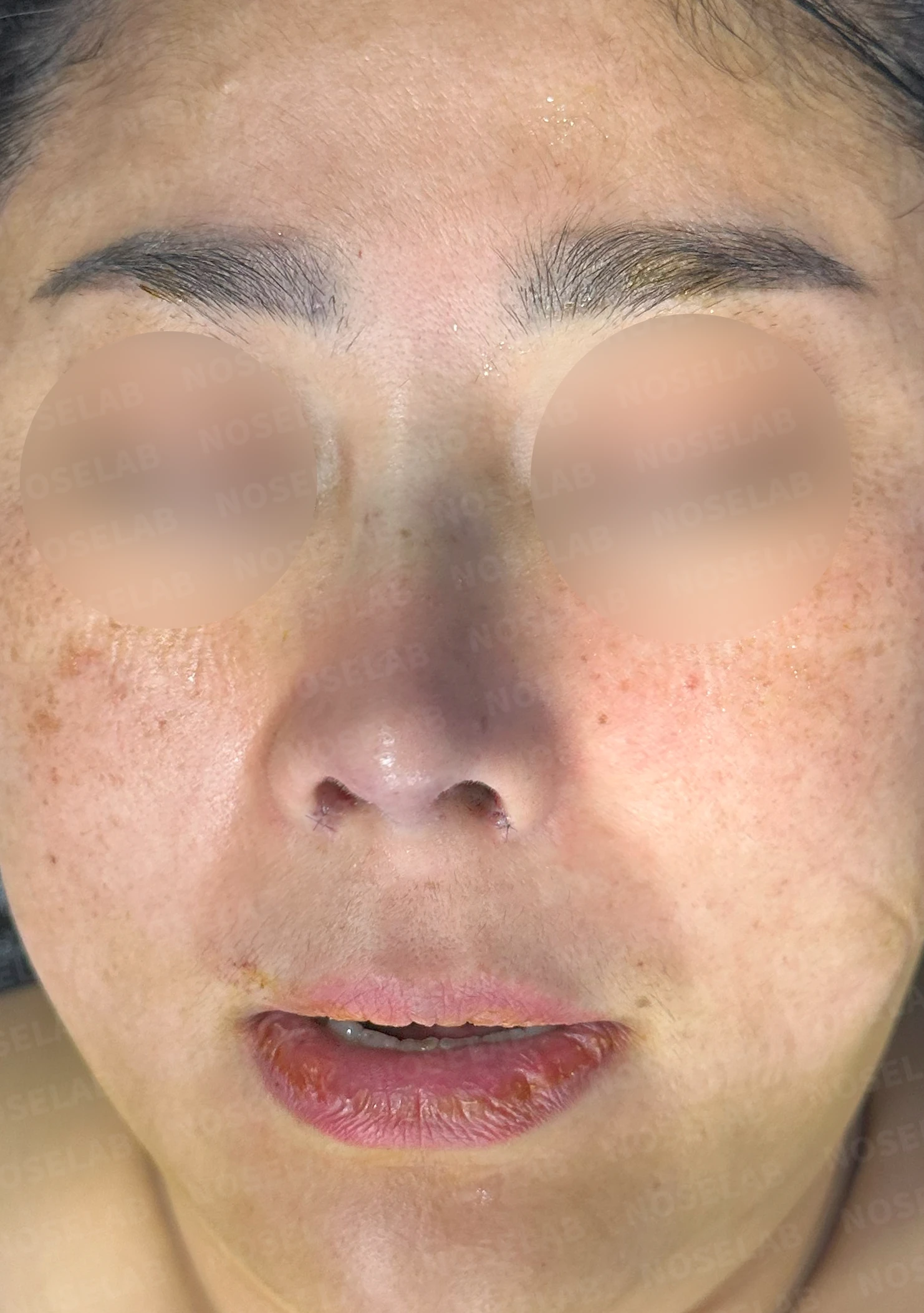짧은 코와 코막힘을 함께 교정하는 방법 — 수술 전 / 수술 직후 0일 직후 사진은 부기가 있는 상태로 최종 결과와 다를 수 있습니다.