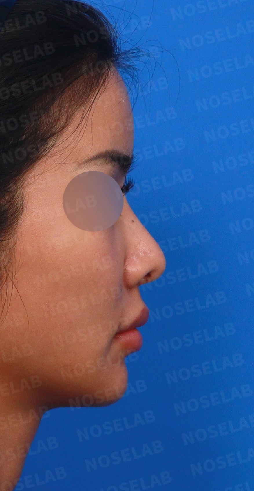 코성형 뒤 코끝이 처지고 웃을 때 퍼지는 이유, 이물질 제거와 코끝 교정 방법 — 디자인 상담 우측 측면, 비스듬한 측면, 비공 사진입니다.
