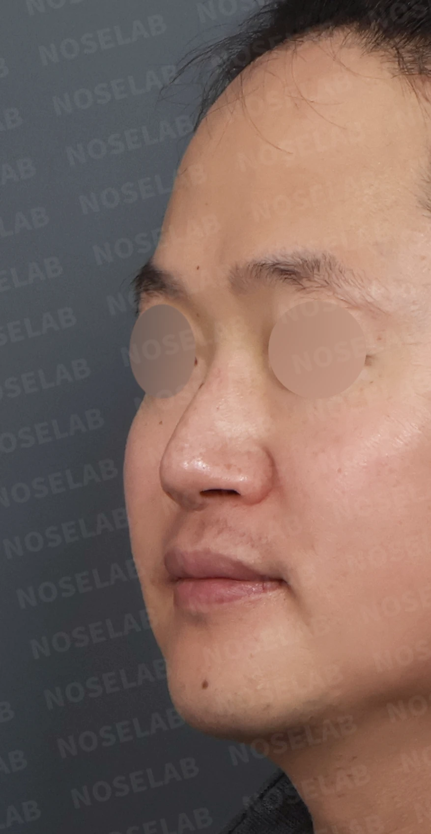 코막힘과 휘어진 비중격, 자가늑연골로 기능과 모양을 동시에 개선 — 디자인 상담 정면, 좌측 측면, 비스듬한 측면 사진입니다.