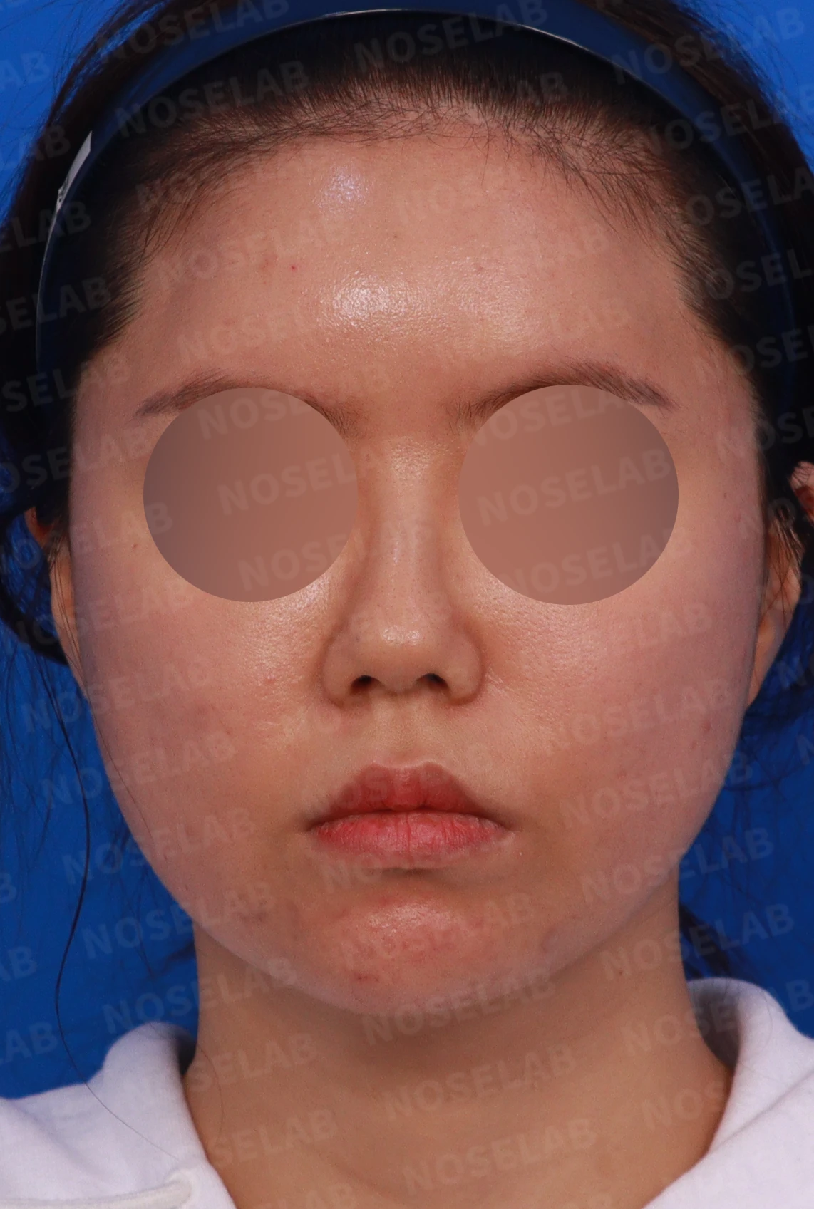 녹지 않고 남은 코 필러와 넓은 콧날개, 원인과 제거·교정 방법 — 디자인 상담 정면 , 좌측 측면 ,비스듬한 측면 사진입니다.