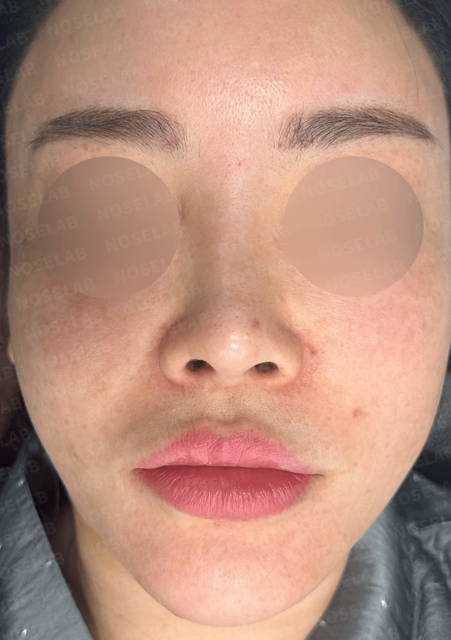 제거했다던 주사 이물질이 남는 이유와 들린 코끝 교정 방법 — 본문 사진 8