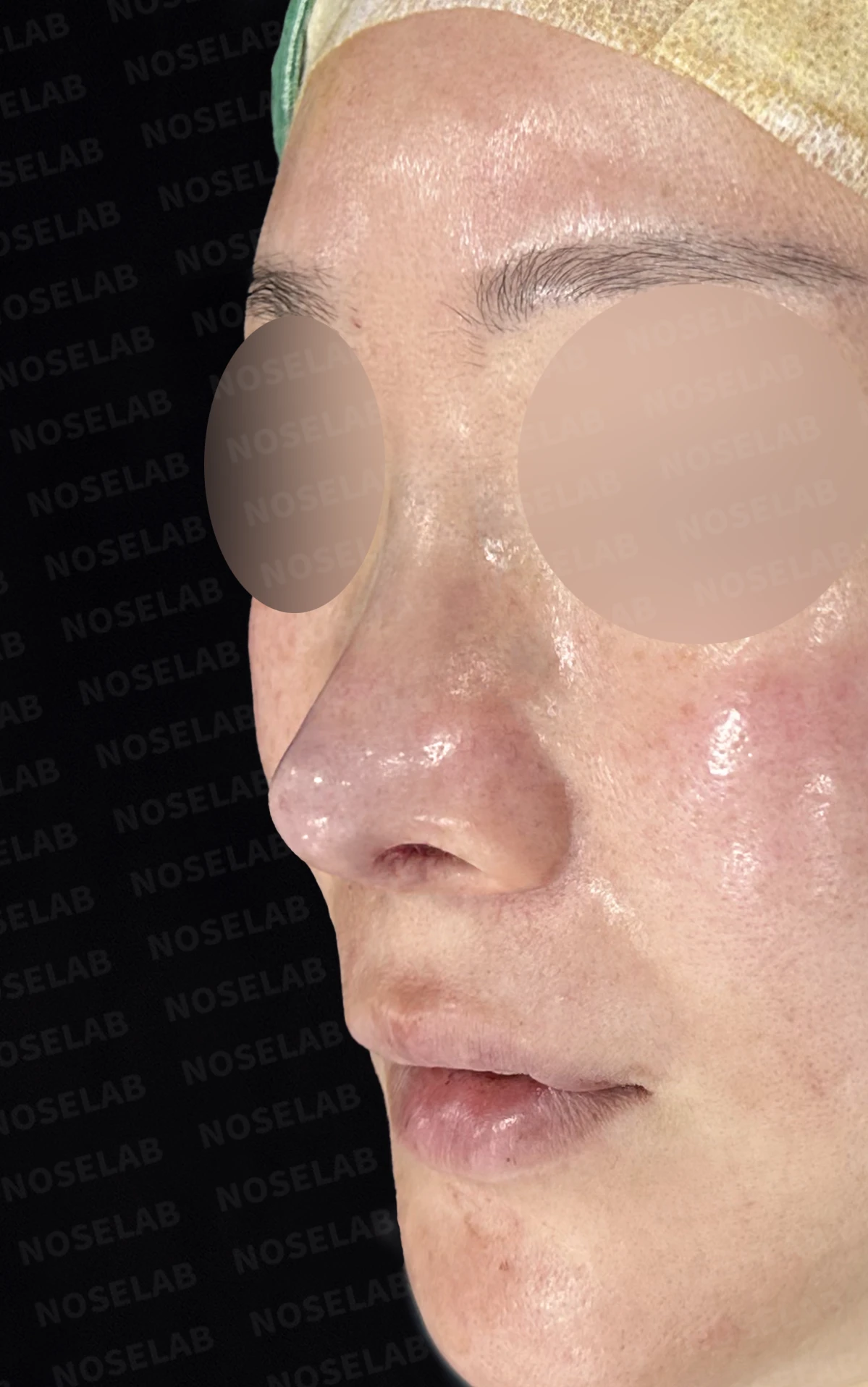 길고 처진 코 교정, 자가늑연골 비중격 재건과 콧대 보형물 교체로 완성한 코재수술 — 전(좌) 직후(우)