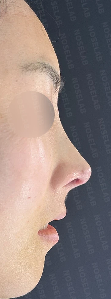 기능성 코성형·휘어진 비주 바로잡기 방법 — 수술 직후 0일 사진 90도 측면, 45도 측면, 정면 직후 사진은 부기가 있는 상태로 최종 결과와 다를 수 있습니다.