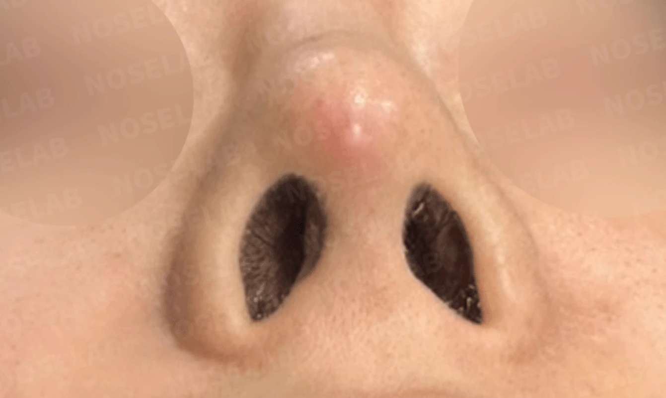실리콘 보형물이 코끝 피부를 뚫고 나오려 할 때, 왜 생기고 어떻게 재건하나 — 본문 사진 19