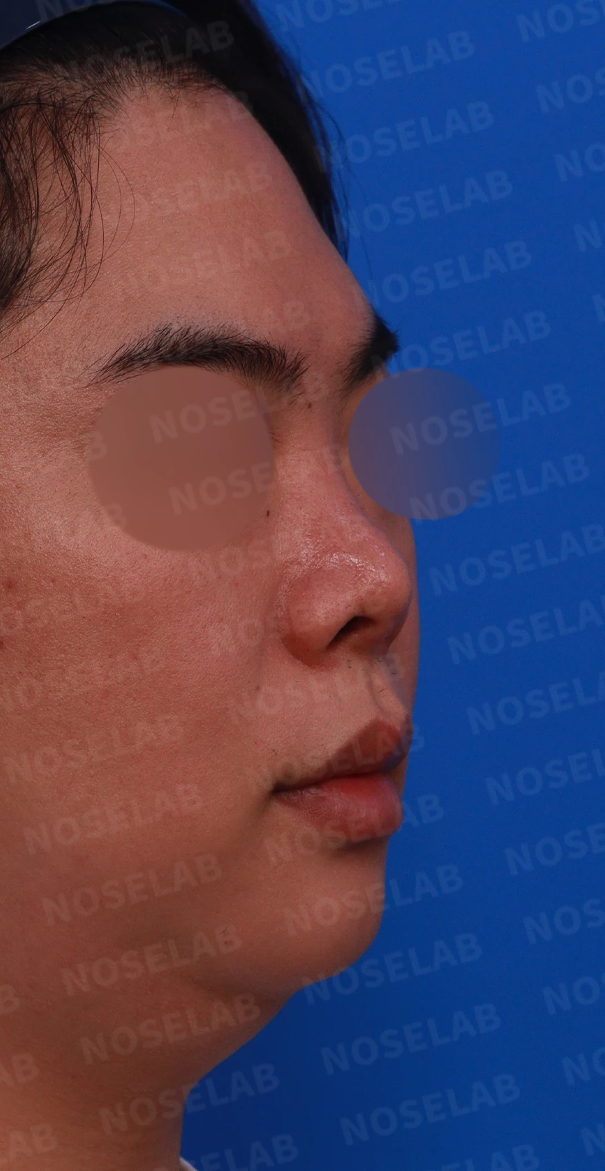 들린 코와 코막힘, 늑연골로 지지 구조를 재건하는 방법 — 디자인 상담 우측 측면, 비스듬한 측면, 비공 사진