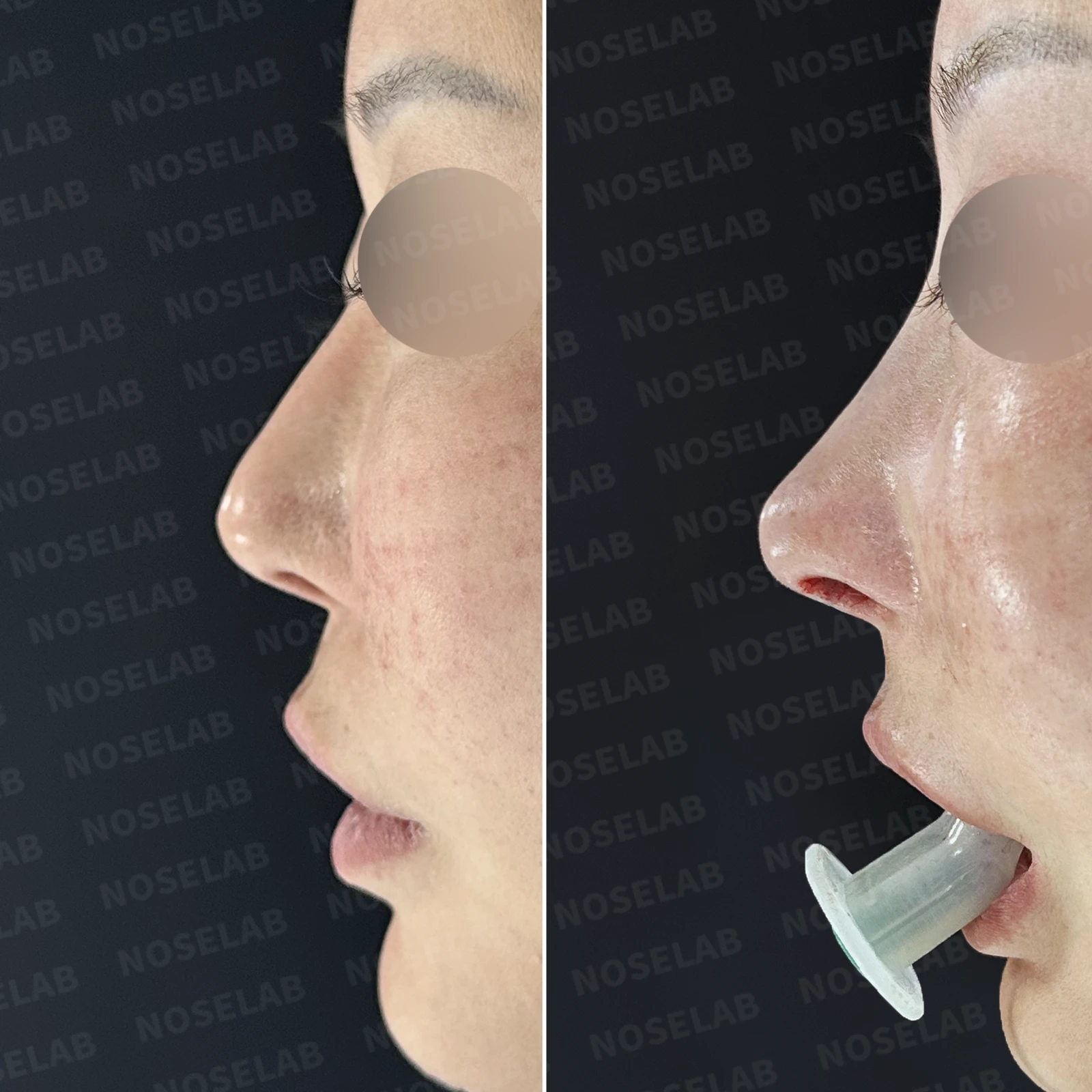 코성형 뒤 코막힘이 더 심해지는 이유, 비중격 재건과 절골 복원은 어떻게 하나 — 본문 사진 20