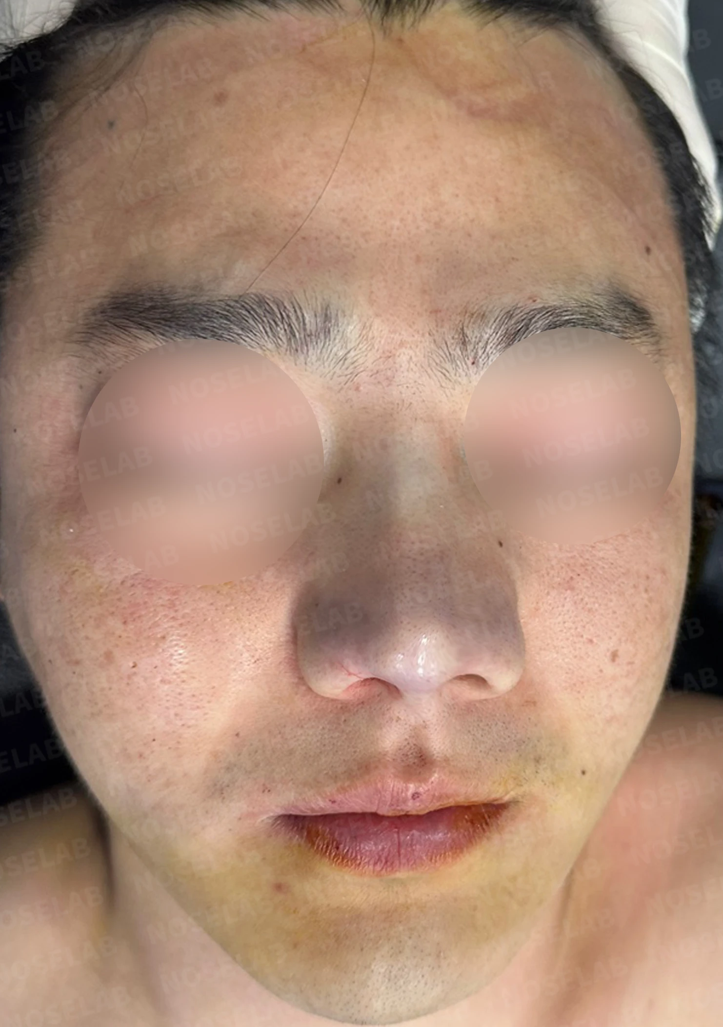 콧구멍 비대칭과 들린 코가 함께 생기는 이유, 늑연골 재건은 어떻게 하나 — 수술 전 / 수술 직후 0일 직후 사진은 부기가 있는 상태로 최종 결과와 다를 수 있습니다.