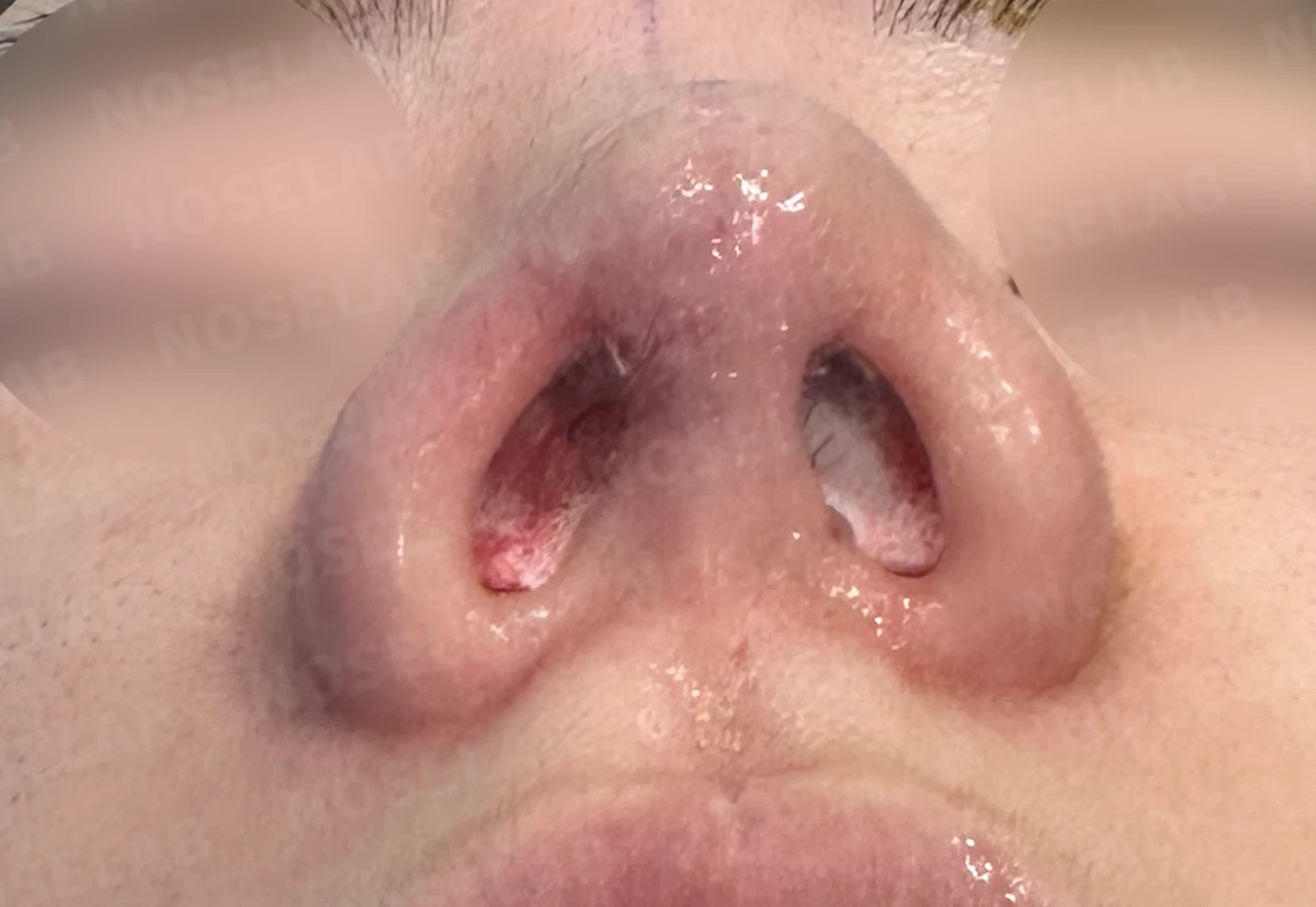 복코 교정과 비주 내리기 방법 — 수술 전 / 수술 직후 0일 직후 사진은 부기가 있는 상태로 최종 결과와 다를 수 있습니다.
