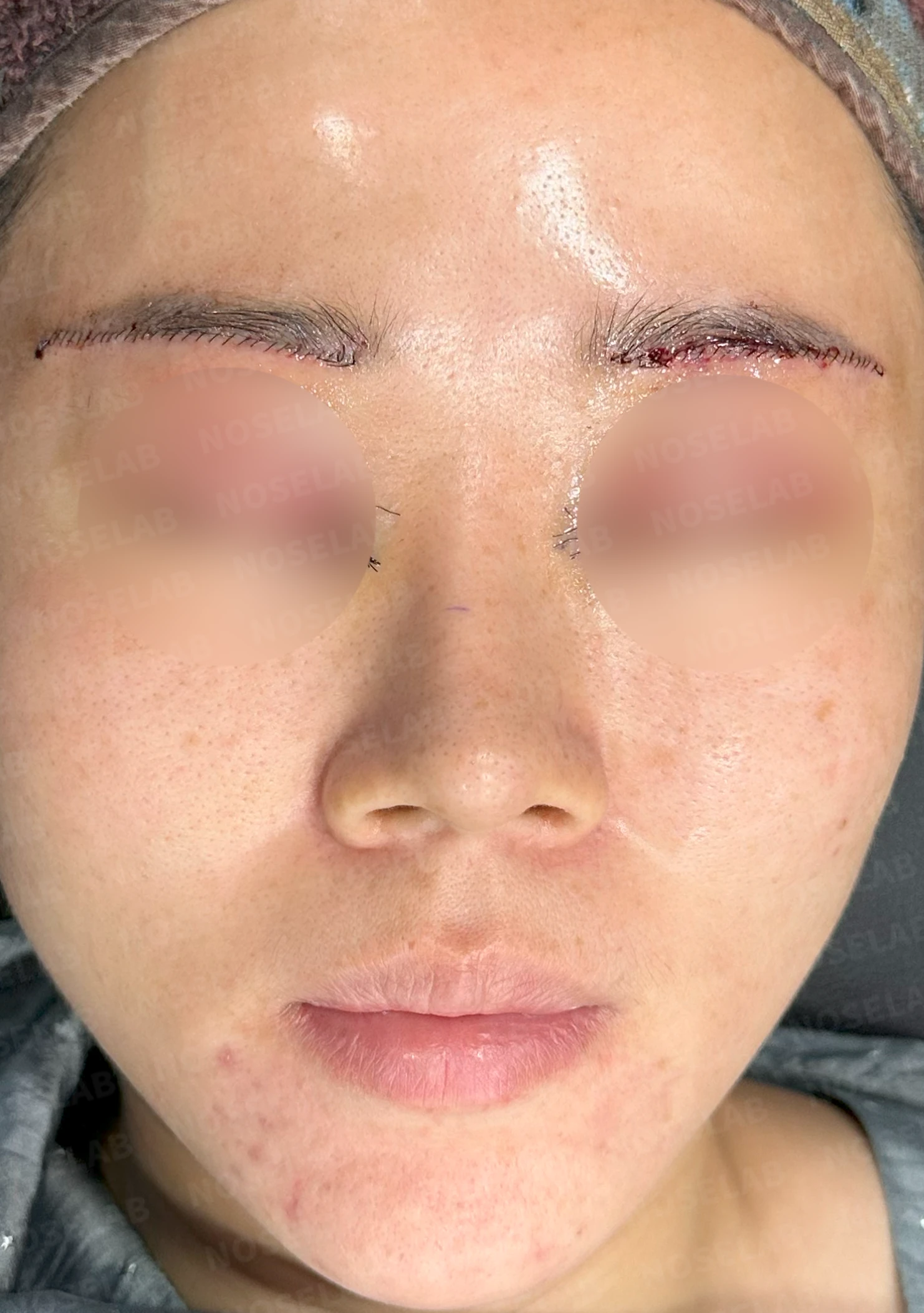 비주 내리기와 비순각 교정을 함께 계획하는 방법 — 수술 전 / 수술 직후 0일 직후 사진은 부기가 있는 상태로 최종 결과와 다를 수 있습니다.