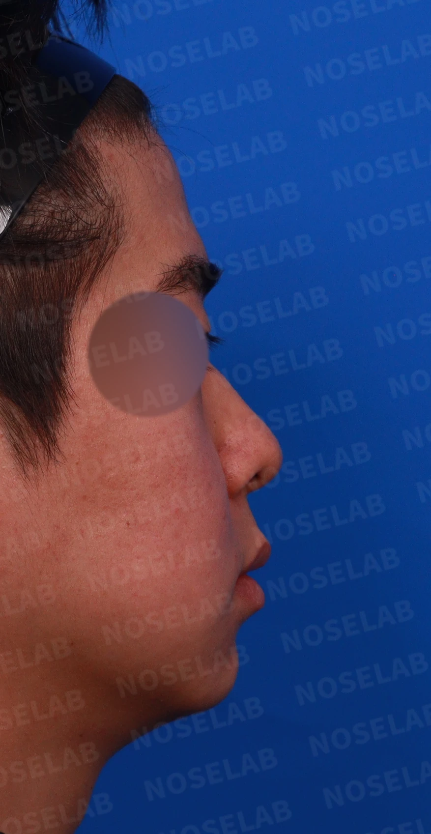 짧고 낮은 코의 지지 구조와 교정 방법 — 디자인 상담 우측 측면, 비스듬한 측면, 비공 사진