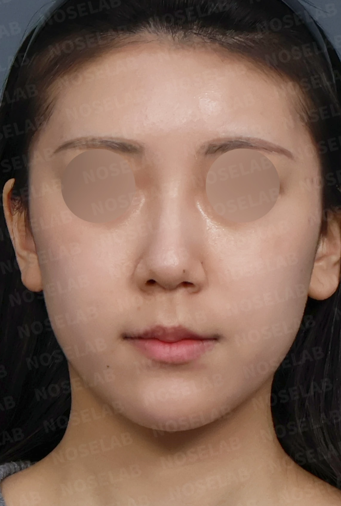 코필러 제거 후 자가늑연골 코성형, 처진 코끝과 메부리코를 자연스럽게 교정 — 디자인 상담 정면, 좌측 측면, 비스듬한 측면 사진입니다.