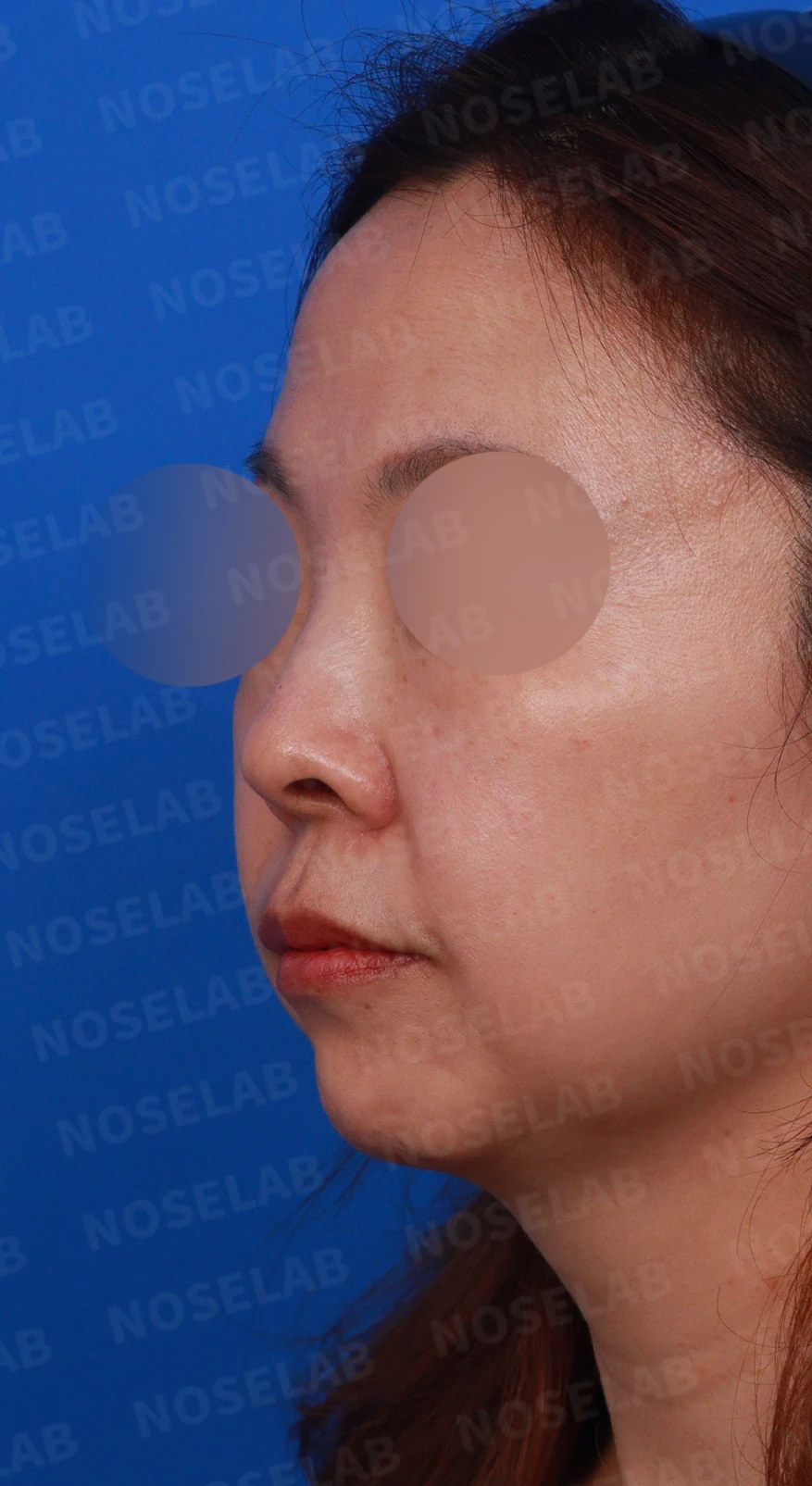 들창코에서 콧구멍이 많이 보이는 이유, 코끝 위치 교정은 어떻게 하나 — 디자인 상담 정면, 좌측 측면, 비스듬한 측면 사진