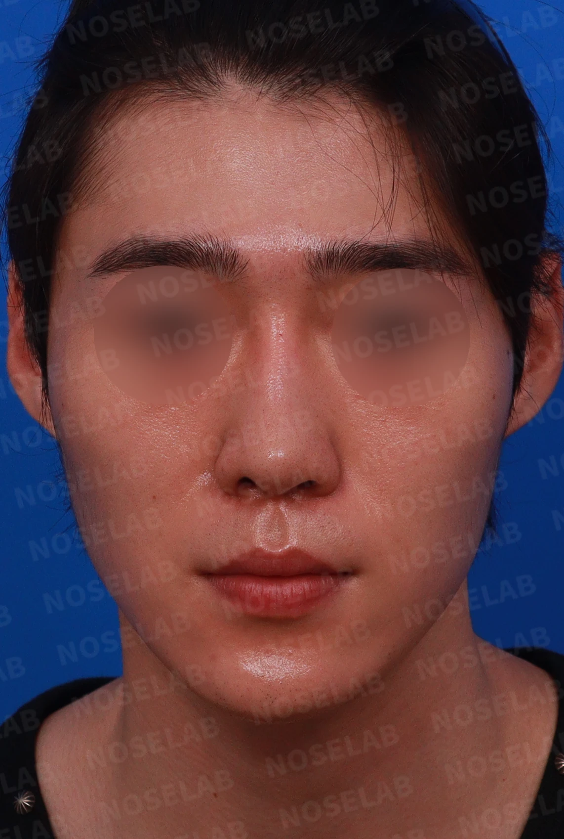 코골절과 반복 재수술 뒤 남는 흉터 조직과 비공 비대칭, 재건 방법 — 디자인 상담 정면 , 좌측 비스듬한 측면 , 측면 사진입니다.