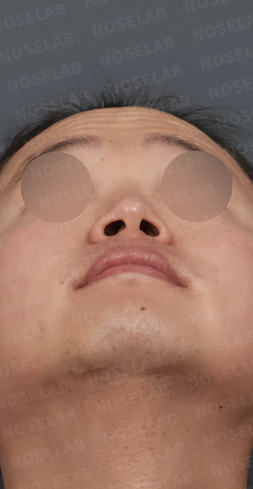 코막힘과 휘어진 비중격, 자가늑연골로 기능과 모양을 동시에 개선 — 디자인 상담 우측 측면, 비스듬한 측면, 비공 사진입니다.