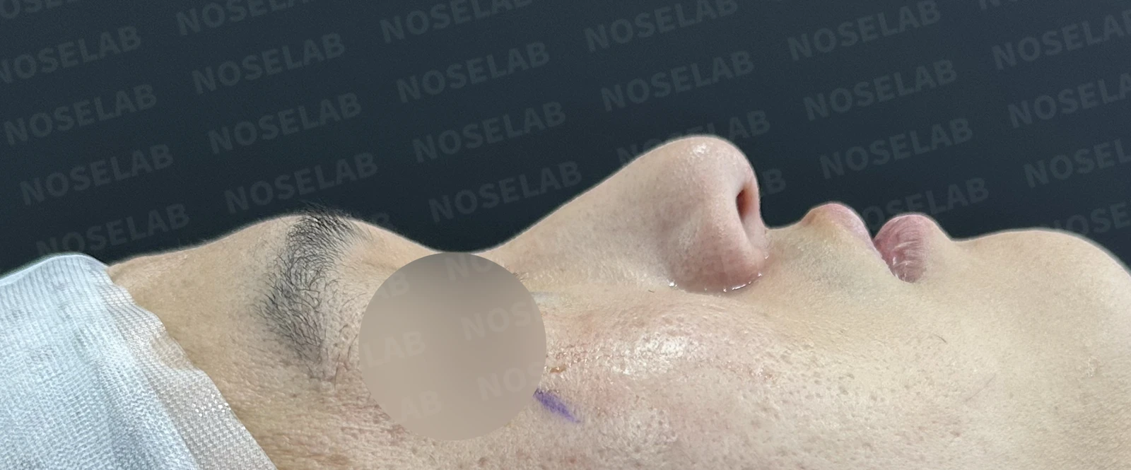 휜코 교정하면 안면 비대칭이 좋아질까요? — 수술 전 / 수술 직후 0일 직후 사진은 부기가 있는 상태로 최종 결과와 다를 수 있습니다.
