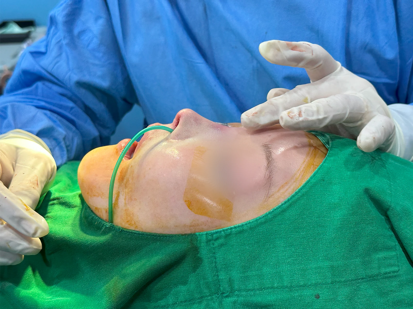 구축코, 메쉬 제거 코성형 사례 — 본문 사진 9